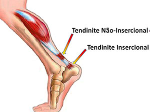 tendinite de aquiles 02